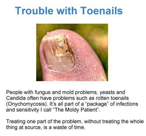 toenail_fungus